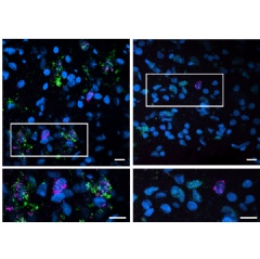 Caption:In an analysis of human brain samples looking for factors associated with neural vulnerability and cognitive resilience amid Alzheimers disease, (see complete caption below)