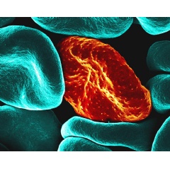 Colorized scanning electron micrograph of red blood cell infected with malaria parasites (orange/red/yellow). SEE Complete Caption Below.